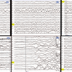 A state of blank as shown by eeg recordings